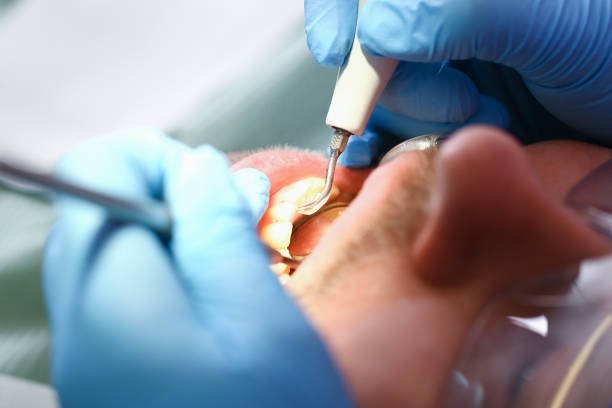 Best Emergency Root Canal Therapy in Pinewood, FL